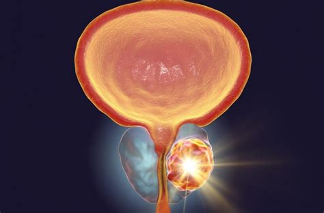 cât de des adenomul de prostată intră în cancer